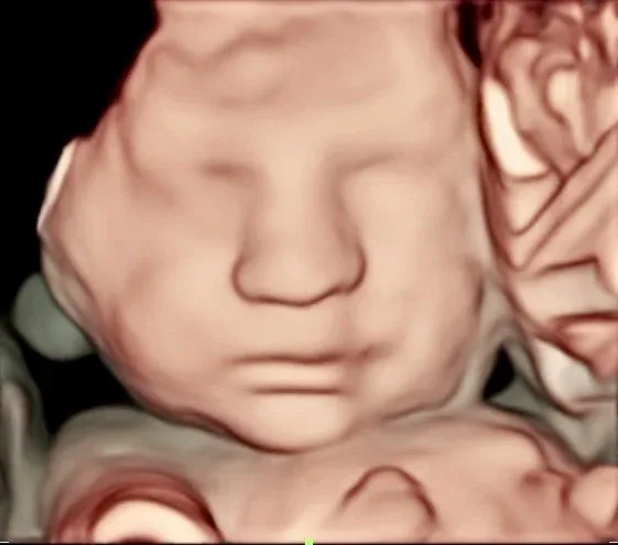 3D ultrasound of a baby resting its cheek